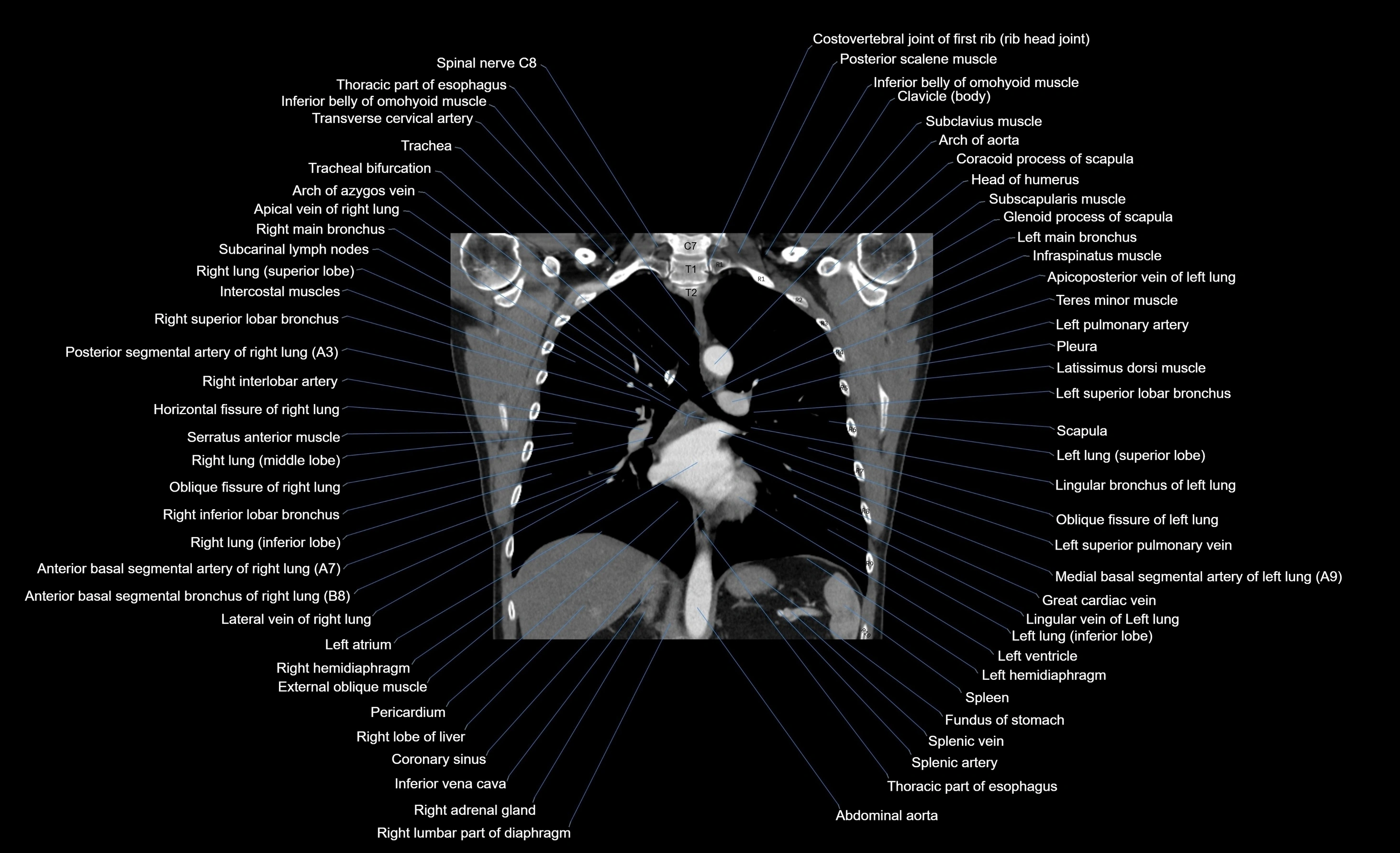 CT chest (thorax) soft tissue window labelled coronal cross sectional anatomy radiology image-00055.webp